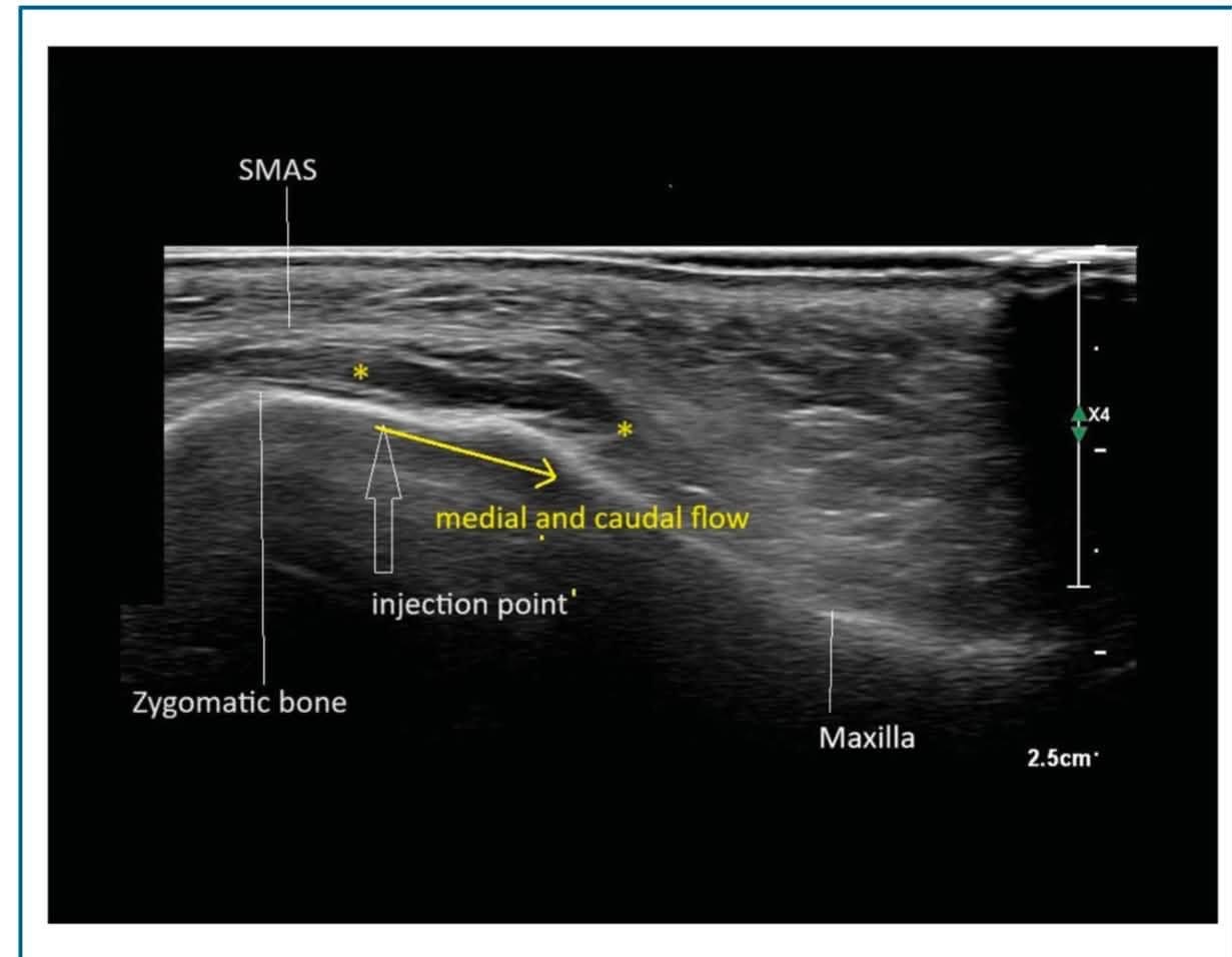 Maxillary deep fat 注射後呈現 medial and caudal flow 的超音波影像